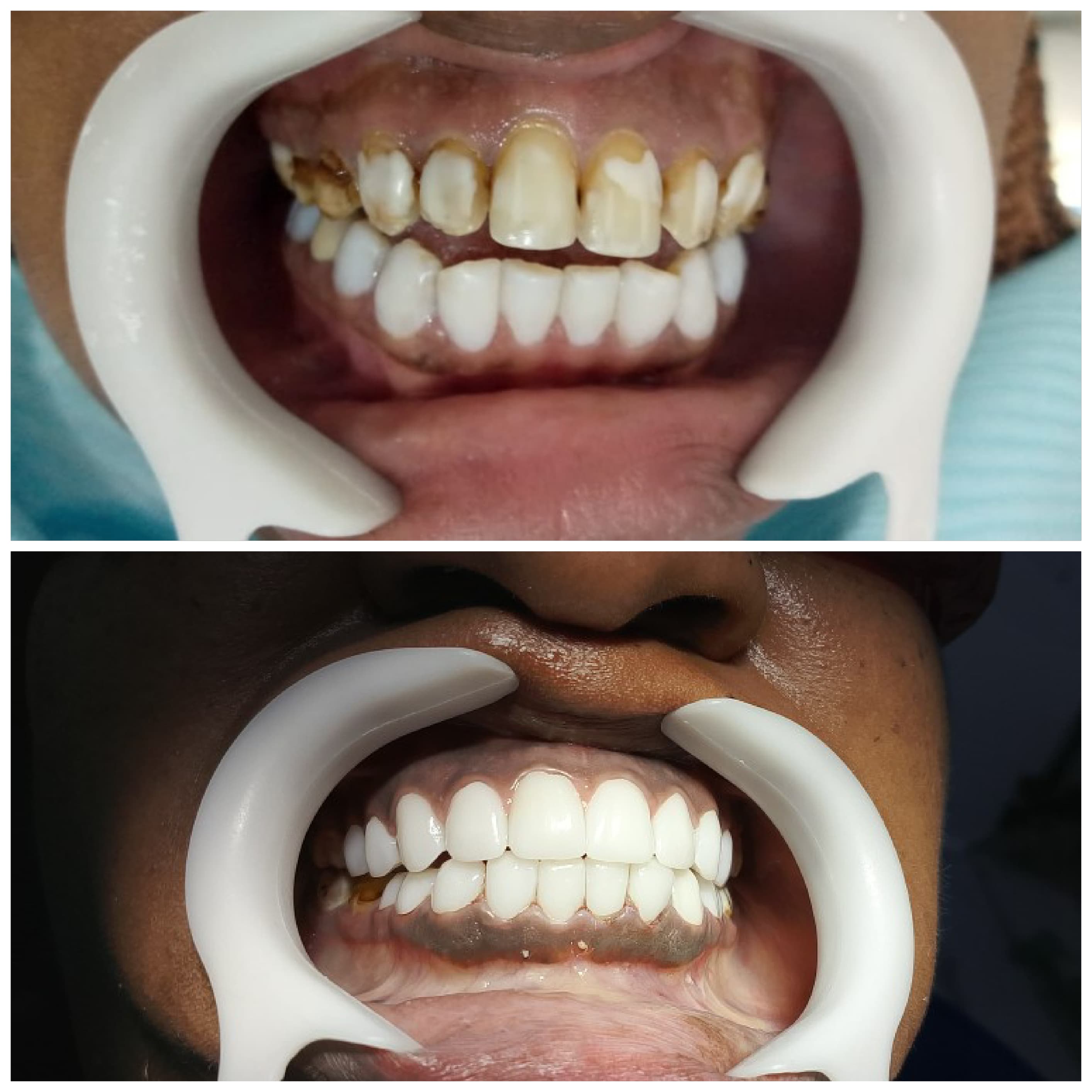 Crowns result 4